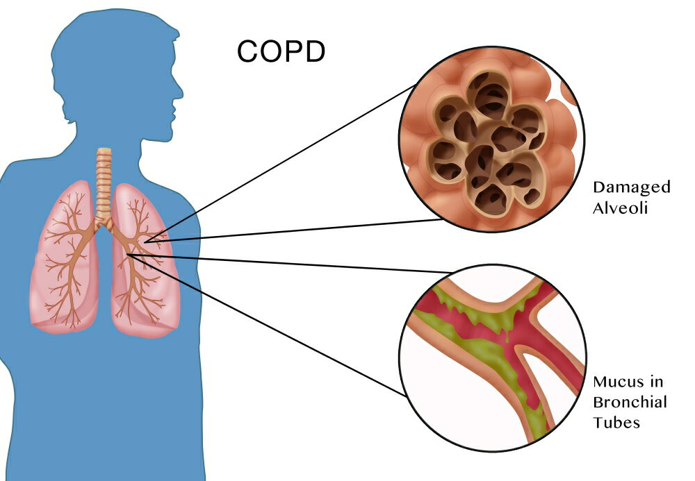 Posterazzi Chronic Obstructive Pulmonary Disease Copd Poster Print