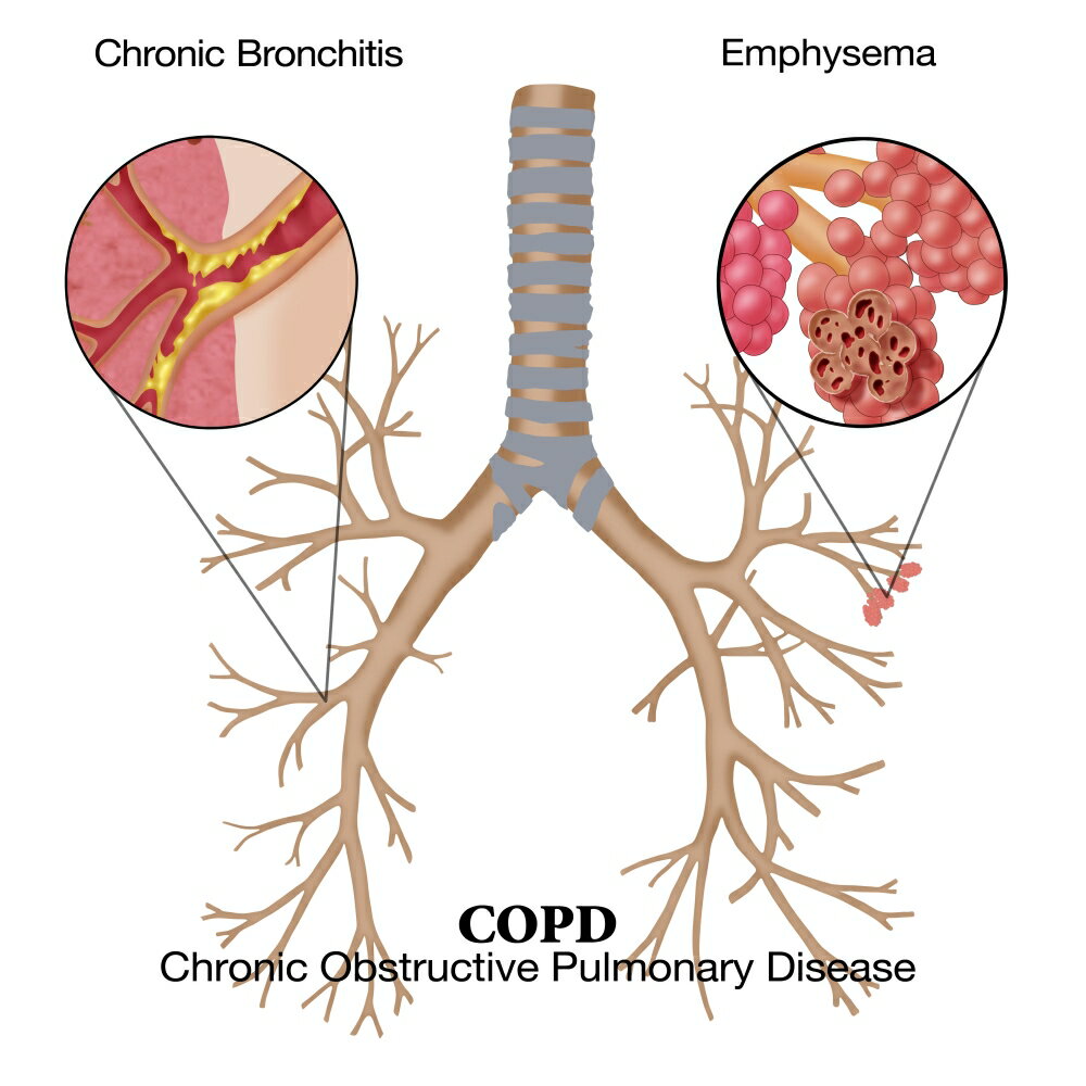 Posterazzi: Chronic Obstructive Pulmonary Disease (COPD) Poster Print ...