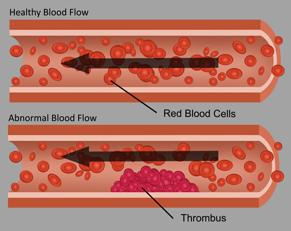 Posterazzi: Healthy and Abnormal Blood Flow Poster Print by Gwen ...