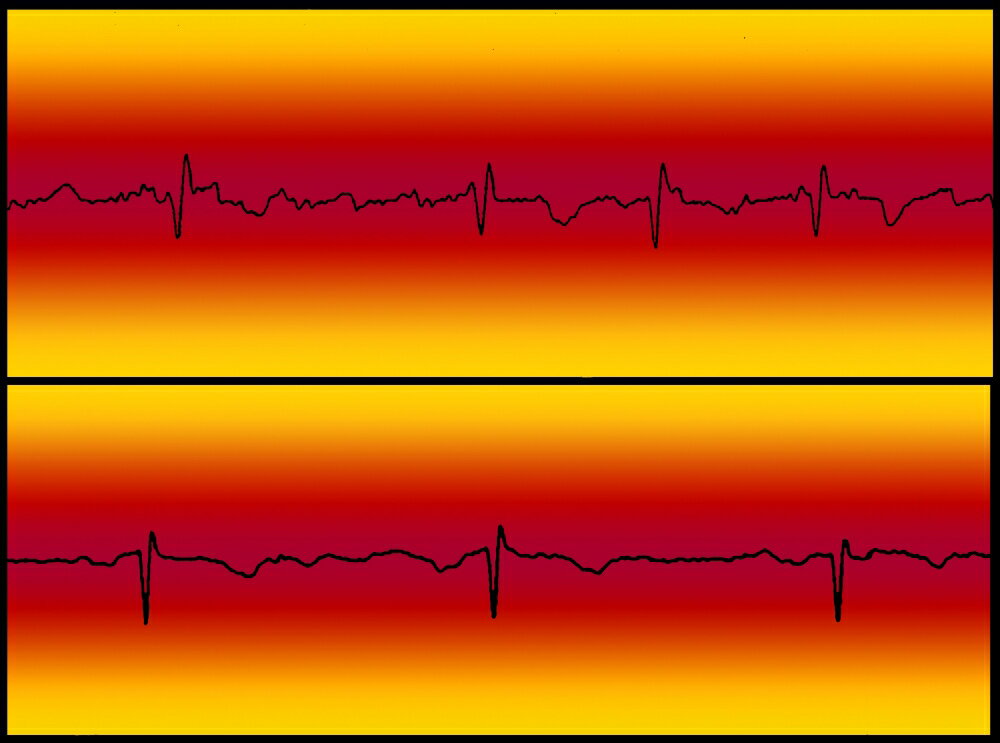 posterazzi-atrial-flutter-normal-heart-beat-rolled-canvas-art