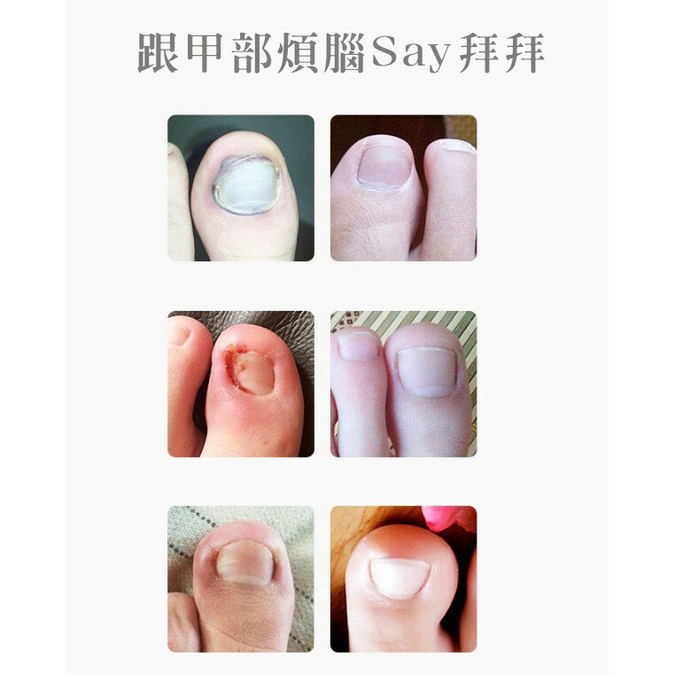 [現貨] 腳趾/指甲 嵌甲 凍甲 指甲剪 死皮剪 指甲 剪刀 嵌甲死皮剪 指甲刀/鉗/剪  加長款專業鷹嘴甲溝鉗剪指甲刀 1