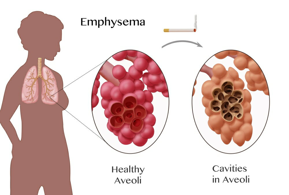 Posterazzi: Alveoli Comparison Emphysema Poster Print By Monica 