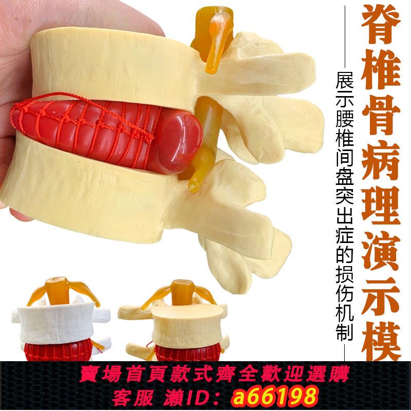 【臺灣公司 可開發票】腰椎擠壓模型 腰椎突出 腰椎盤突出模型 脊柱脊椎骨病理演示模型