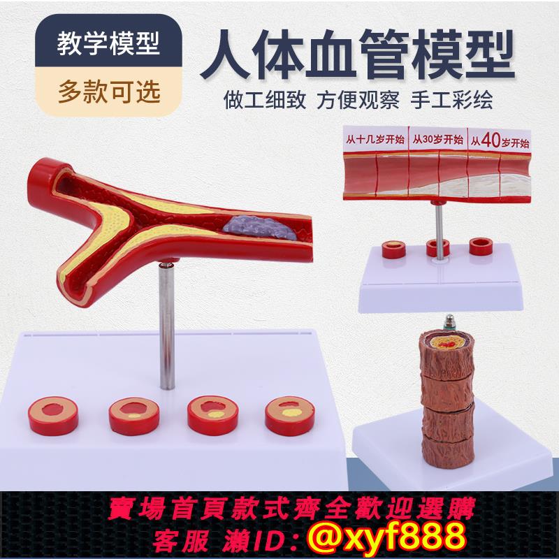 {可打統編 保固一年}血管堵塞動支脈粥樣硬化心血管模型 堵塞程度變化 病理血管模型