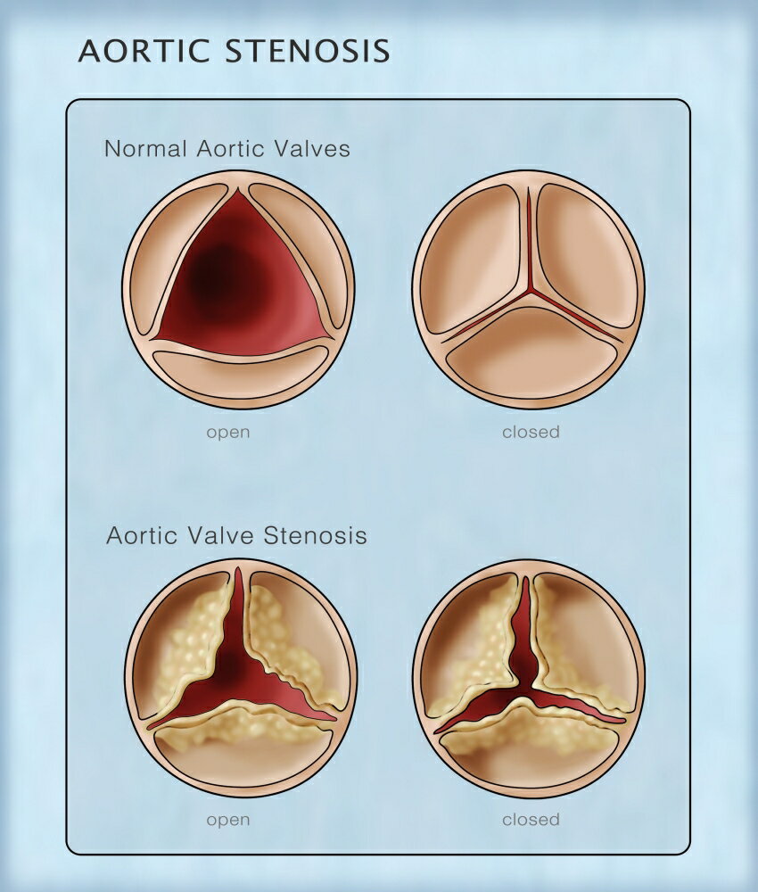 Causes Of Aortic Stenosis My Xxx Hot Girl