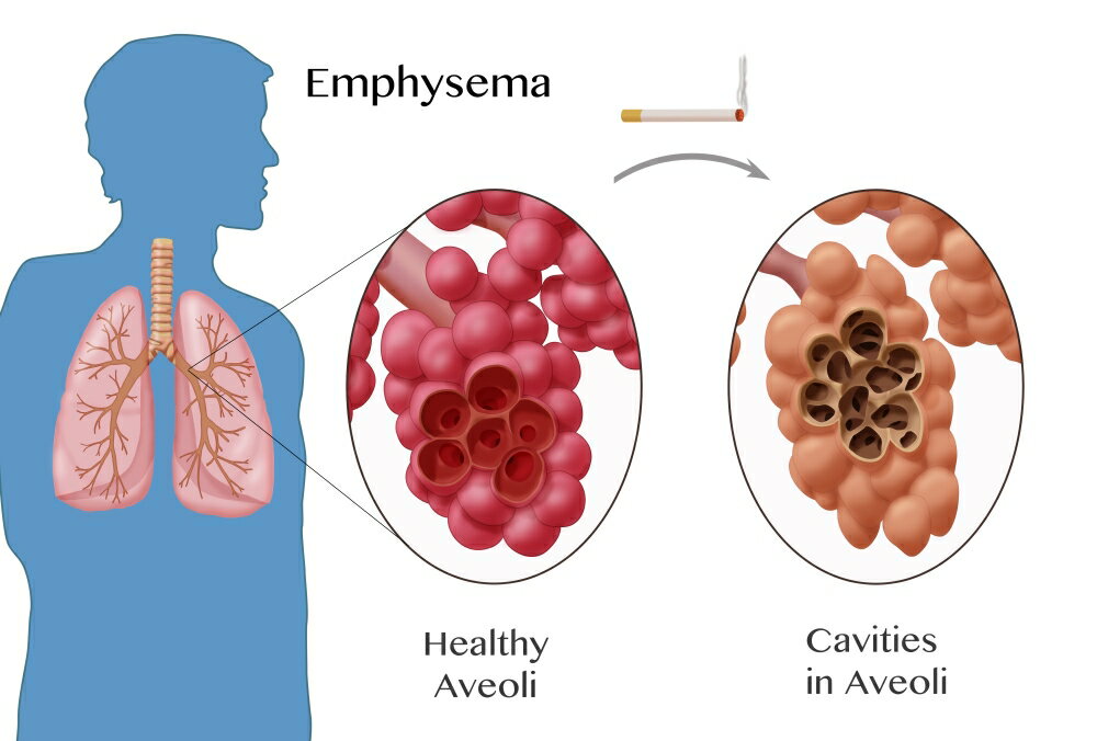 Posterazzi: Alveoli Comparison Emphysema Poster Print by Monica ...