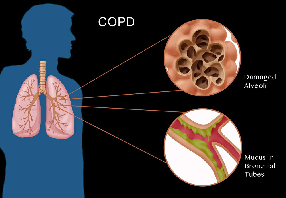 Posterazzi: Chronic Obstructive Pulmonary Disease (COPD) Poster Print ...