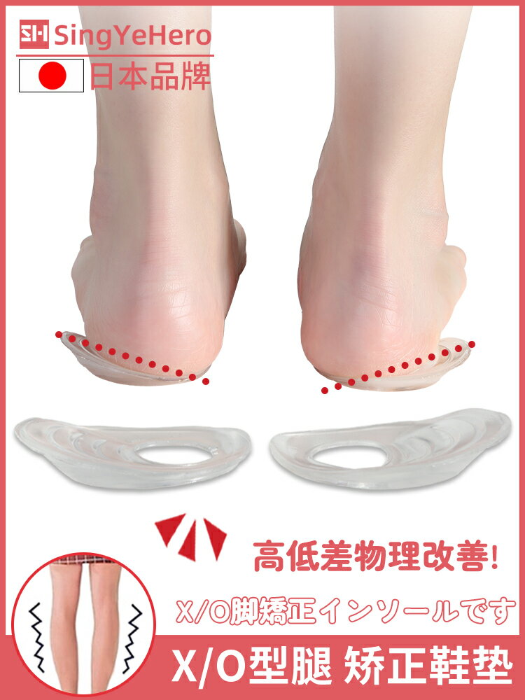 日本X/0型腿矯正鞋墊小腿外翻內外八字糾正足底直腿神器兒童成人