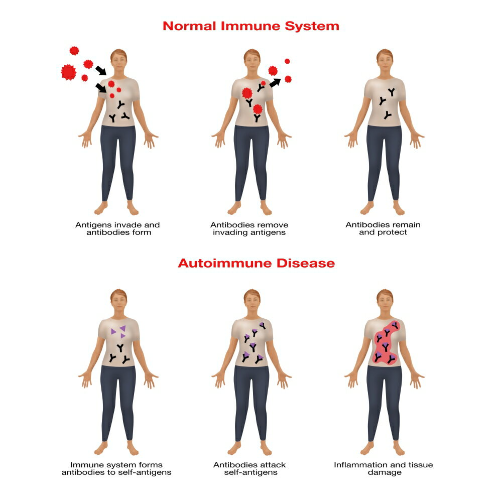 posterazzi-normal-immune-system-autoimmune-disease-poster-print-by