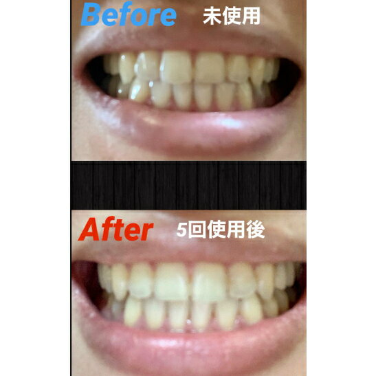 【日本出貨丨火箭出貨】DENTALLOVER 牙齒美白 家庭用 附屬凝膠 EC001 7