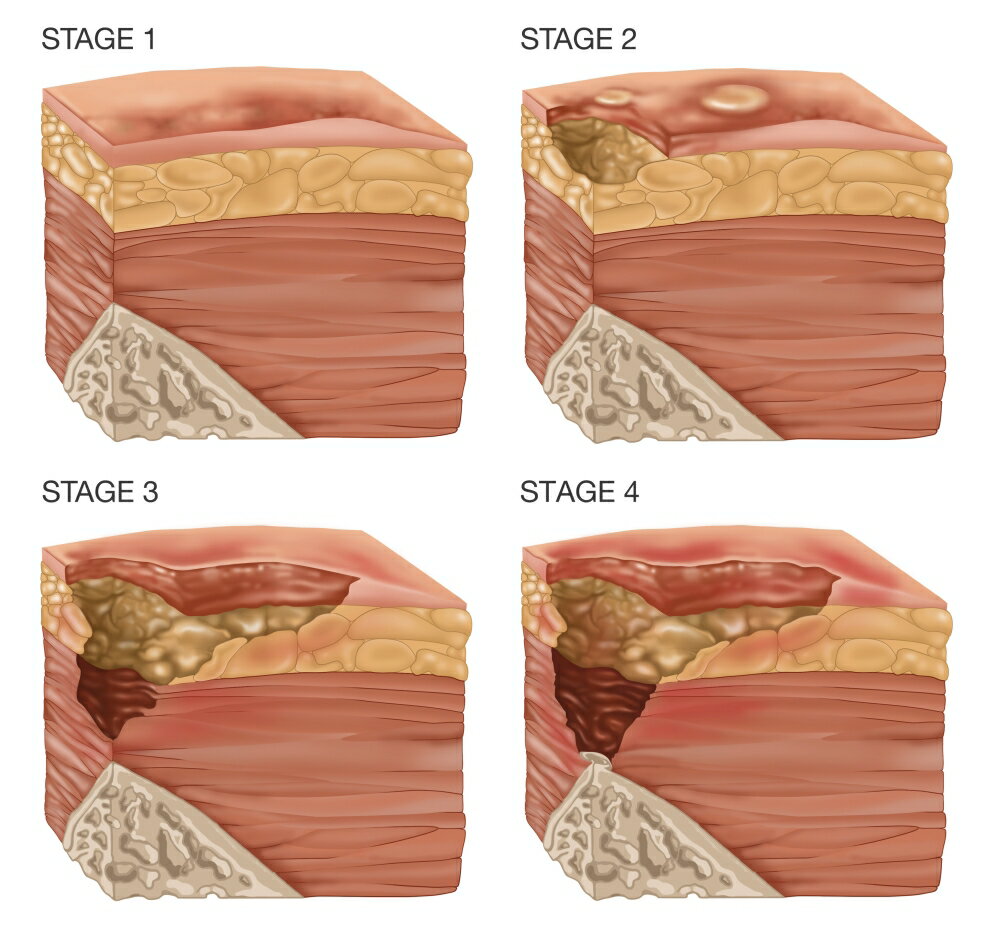 Posterazzi: 4 Stages Of A Bedsore Illustration Rolled Canvas Art - Gwen ...