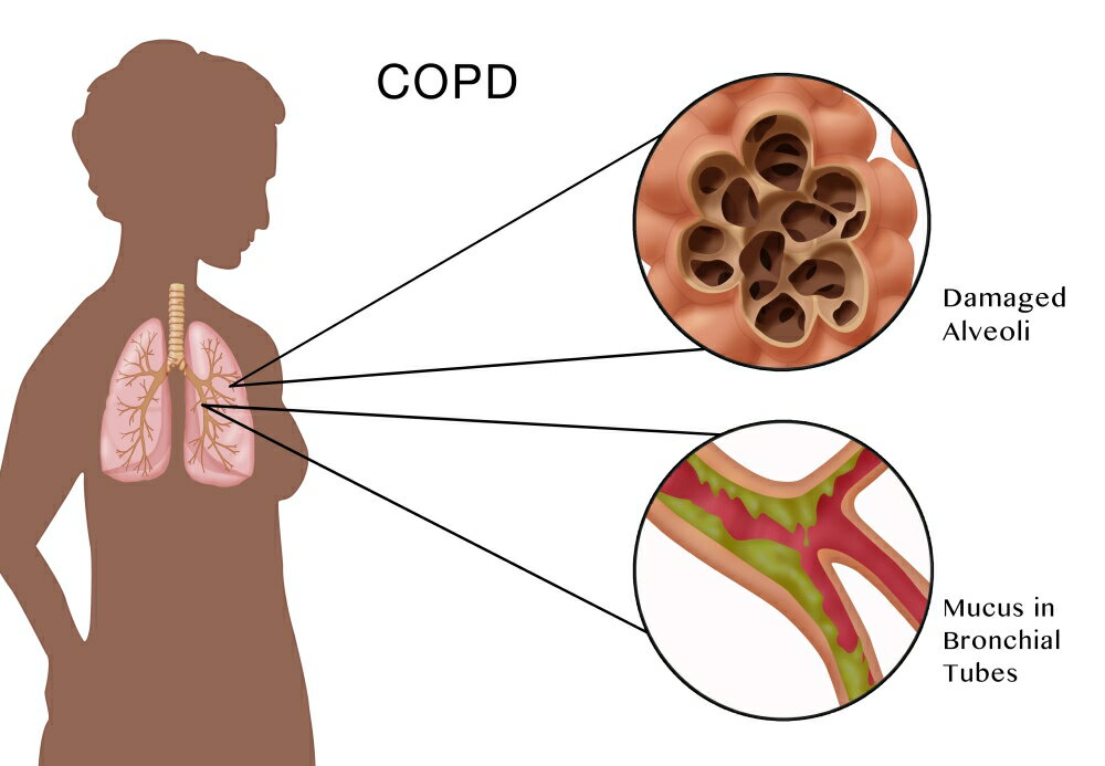 Posterazzi: Chronic Obstructive Pulmonary Disease (COPD) Rolled Canvas ...