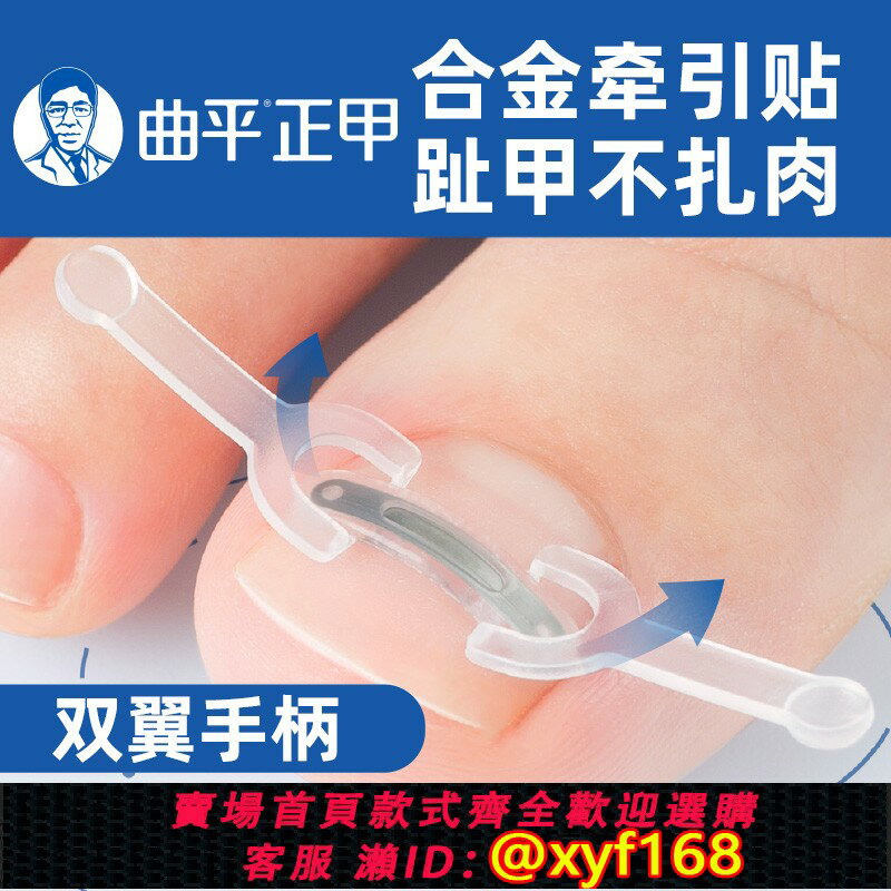 {臺灣公司貨 可打統編}曲平 甲溝嵌甲矯正器正甲貼片腳趾甲蓋內嵌神器足科炎指甲絲醫生