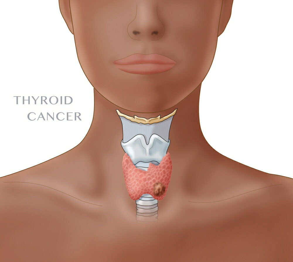 Posterazzi: Thyroid Cancer Poster Print by Monica SchroederScience ...