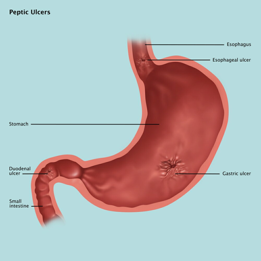 Posterazzi: Stomach Ulcers Illustration Rolled Canvas Art - Gwen ...